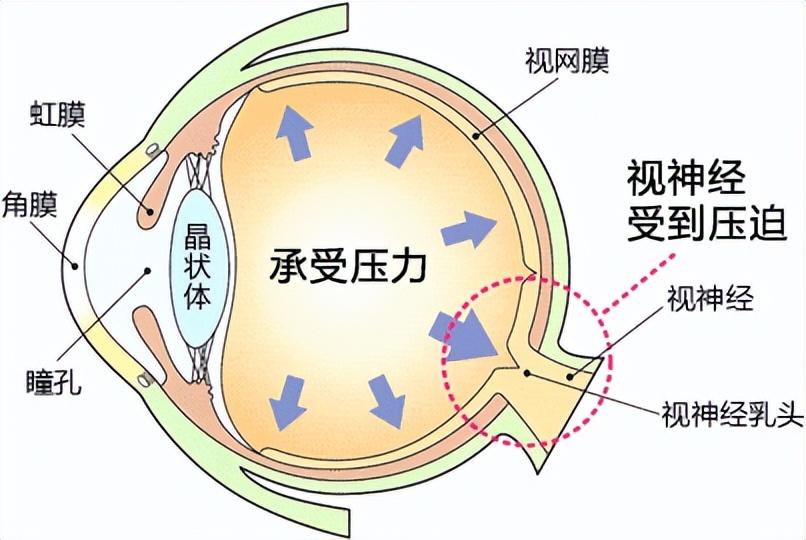 最新降眼壓藥物，治療眼壓升高的新選擇
